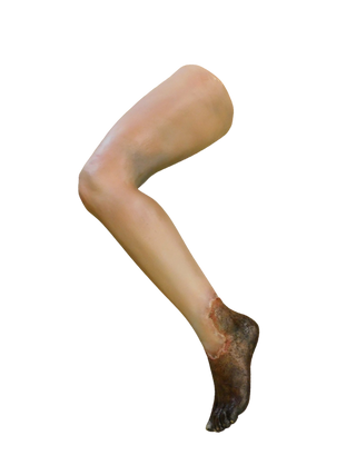 Dura Gangrene Sonia Leg