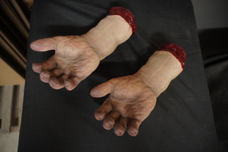 Swollen Hand