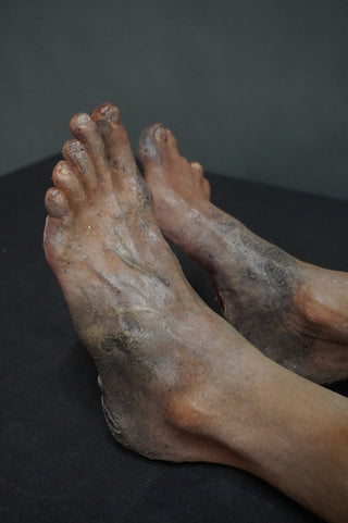 Leslie Legs with Burns and Blisters