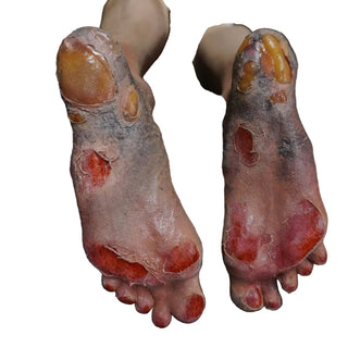 Leslie Legs with Burns and Blisters