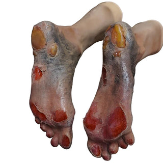 Leslie Legs with Burns and Blisters