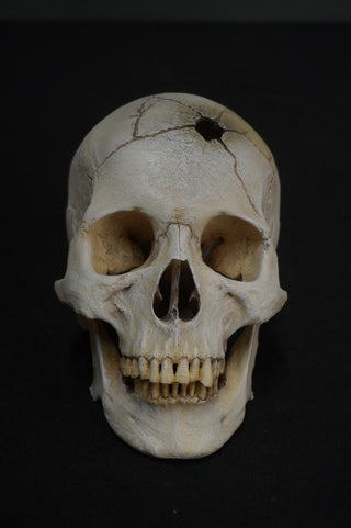 Gunshot Trauma Forensic Skull