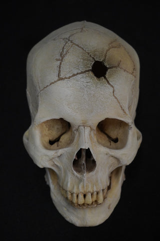 Gunshot Trauma Forensic Skull