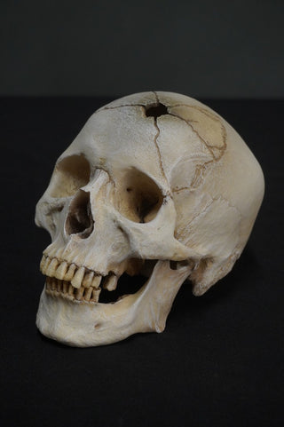 Gunshot Trauma Forensic Skull