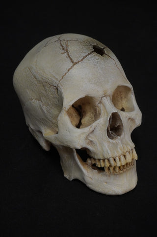 Gunshot Trauma Forensic Skull