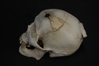 Gunshot Trauma Forensic Skull