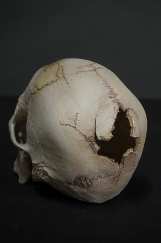 Gunshot Trauma Forensic Skull