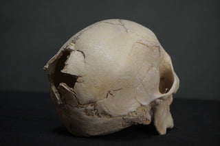 Gunshot Trauma Forensic Skull