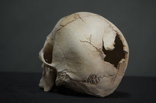 Gunshot Trauma Forensic Skull