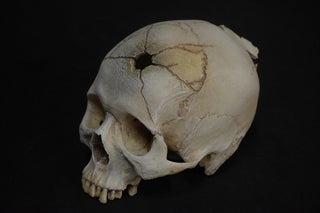 Gunshot Trauma Forensic Skull