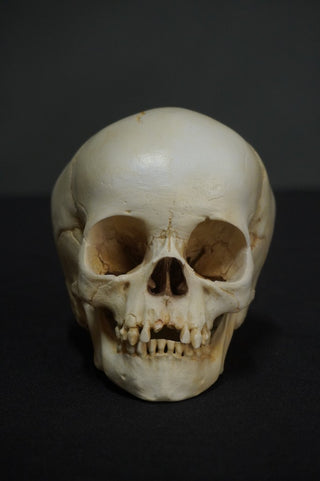 Toddler Forensic Skull with Pediatric Abuse Fractures