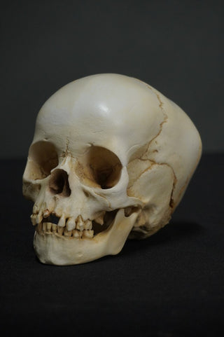 Toddler Forensic Skull with Pediatric Abuse Fractures
