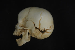 Toddler Forensic Skull with Pediatric Abuse Fractures