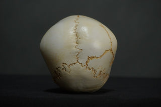 Toddler Forensic Skull with Pediatric Abuse Fractures