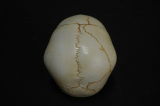 Toddler Forensic Skull with Pediatric Abuse Fractures