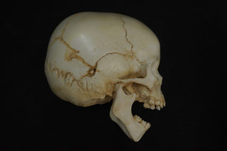 Toddler Forensic Skull with Pediatric Abuse Fractures