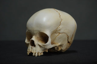 Toddler Forensic Skull with Pediatric Abuse Fractures
