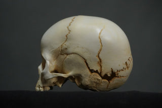 Toddler Forensic Skull with Pediatric Abuse Fractures