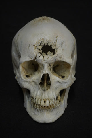 Blunt Force Trauma Lifecast Female Skull