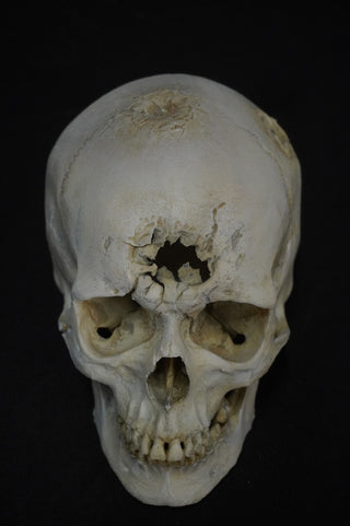 Blunt Force Trauma Lifecast Female Skull