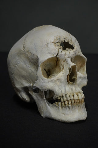Blunt Force Trauma Lifecast Female Skull