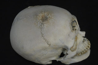 Blunt Force Trauma Lifecast Female Skull