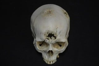 Blunt Force Trauma Lifecast Female Skull