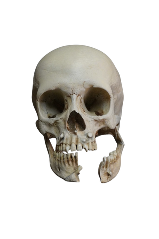 Juvenile Lifecast Skull with Jaw Fracture