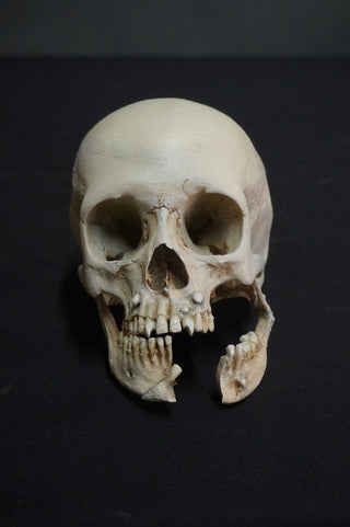 Juvenile Forensic Skull with Jaw Fracture