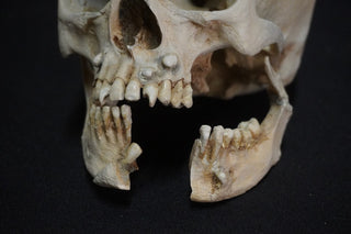 Juvenile Forensic Skull with Jaw Fracture