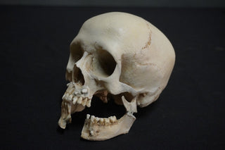 Juvenile Forensic Skull with Jaw Fracture