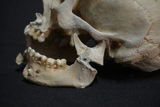 Juvenile Forensic Skull with Jaw Fracture