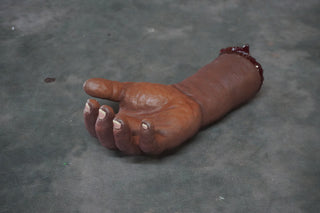 Swollen Hand