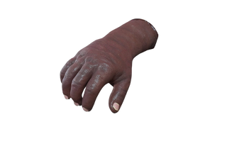 Swollen Hand