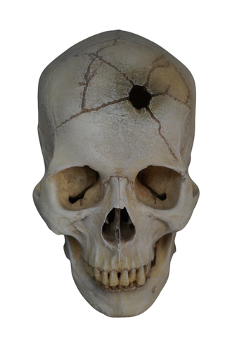 Gunshot Trauma Lifecast Male Skull