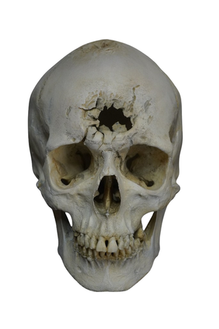 Blunt Force Trauma Lifecast Female Skull