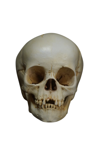 Lifecast Toddler Skull with Pediatric Abuse Fractures
