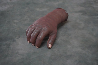 Swollen Hand