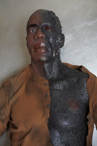 Burn Wound Richard Body