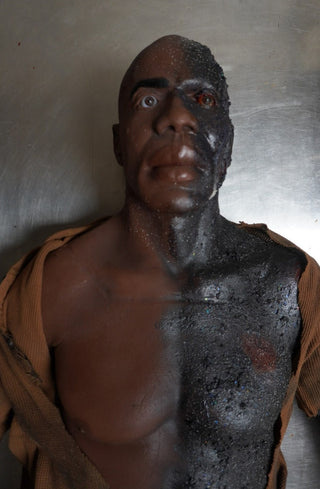 Burn Wound Richard Body
