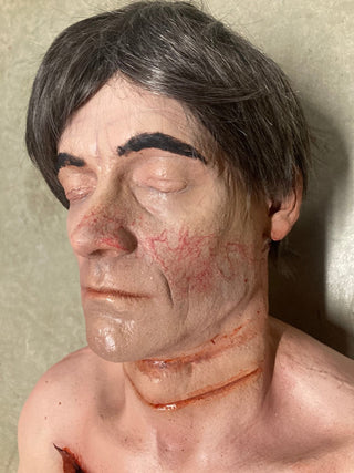 Types of Bruises Jack Dura Autopsy Body