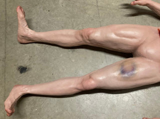Types of Bruises Jack Dura Autopsy Body