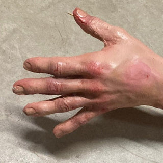 Types of Bruises Jack Dura Autopsy Body