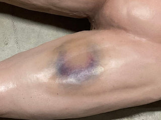 Types of Bruises Jack Dura Autopsy Body