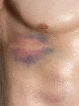 Types of Bruises Jack Dura Autopsy Body