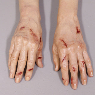 Dura Laceration Leslie Hands