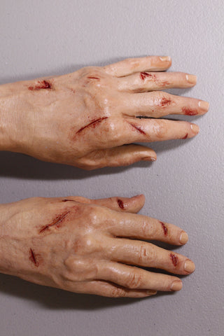 Dura Laceration Leslie Hands