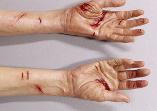 Dura Laceration Leslie Hands