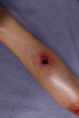 Types of Wounds Dura Yong Arm